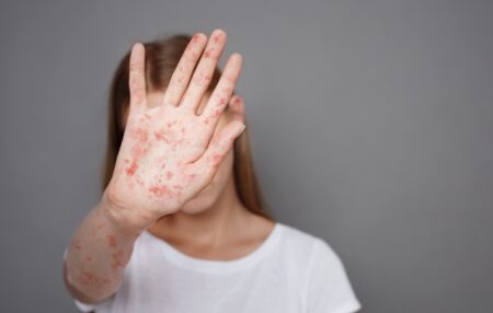 Alerta por el mayor brote de sarampión en 30 años: Conoce síntomas y prevención efectiva