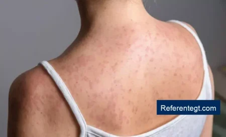 Todo lo que necesitas saber sobre el sarampión en Guatemala: síntomas, contagio y prevención efectivas.