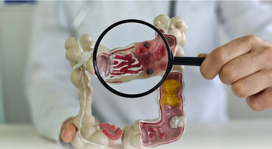 Descubre las Razones Clave para Realizarte una Colonoscopia Anticipadamente