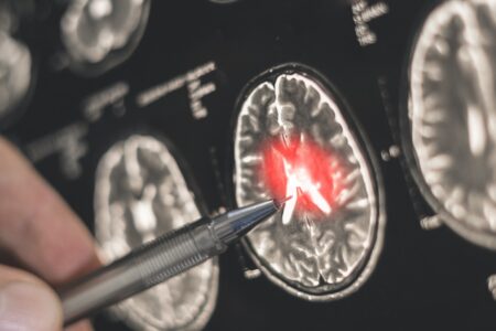 Revolucionario ensayo clínico investiga oncovirus como tratamiento para tumores cerebrales en niños con mal pronóstico.