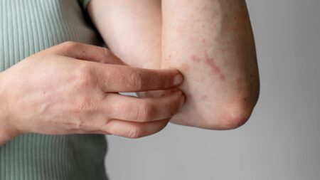Guía completa para reconocer, tratar y prevenir el sarpullido por calor eficazmente