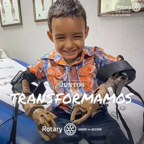 Jornada de prótesis de manos gratuita del Club Rotario Guatemala de la Ermita