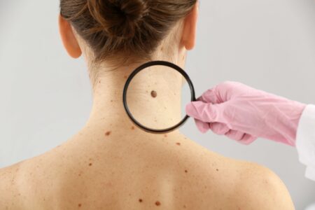 Descubre los signos ocultos del cáncer más frecuente y cómo detectarlo a tiempo.